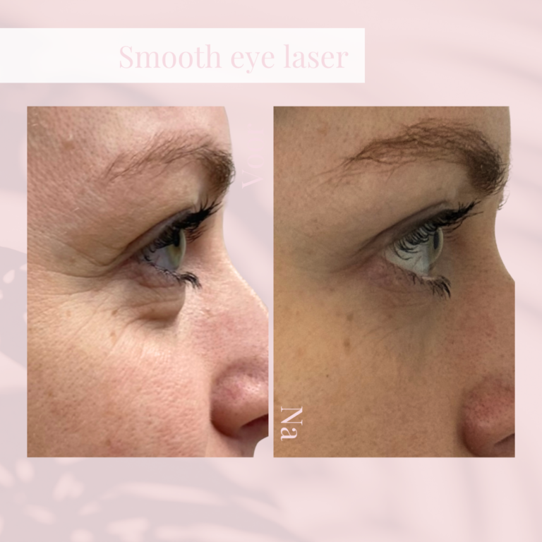Avant et après un traitement laser SmoothEye