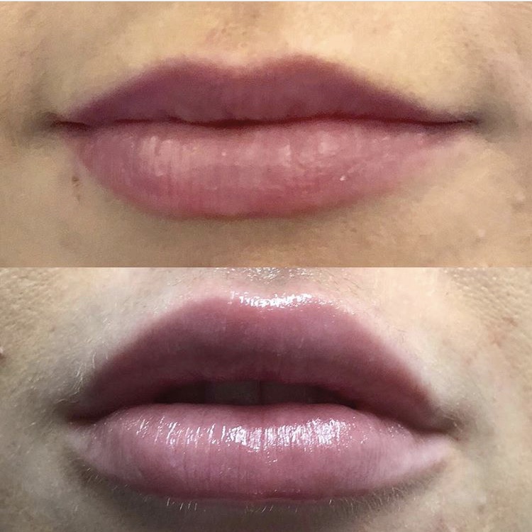 Lipfiller 1ml