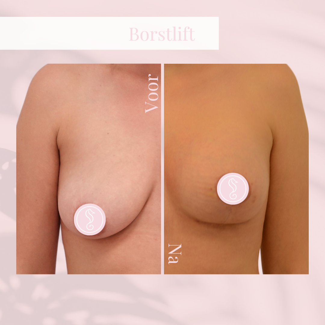Before and after breast lift results