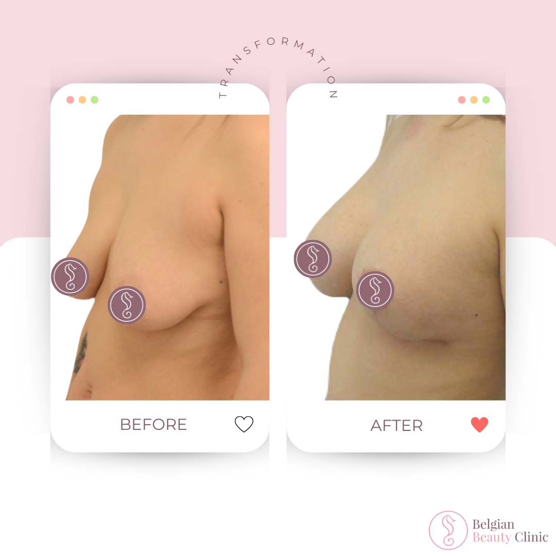 Before and after breast lift transformation