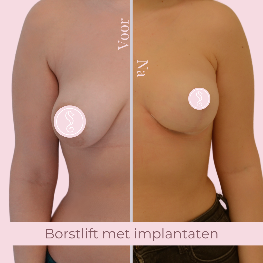 Before and after breast lift surgery