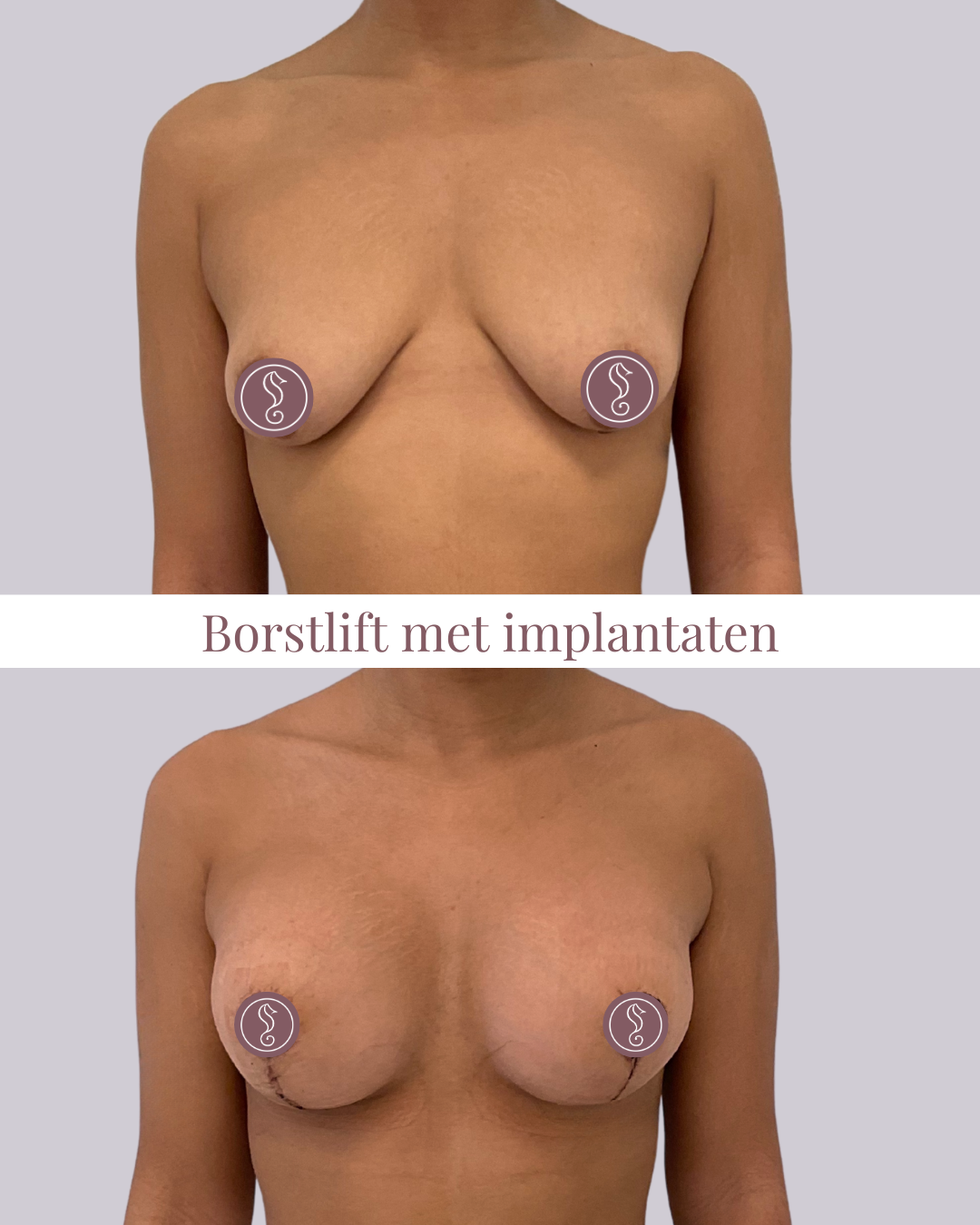 Before and after breast lift surgery