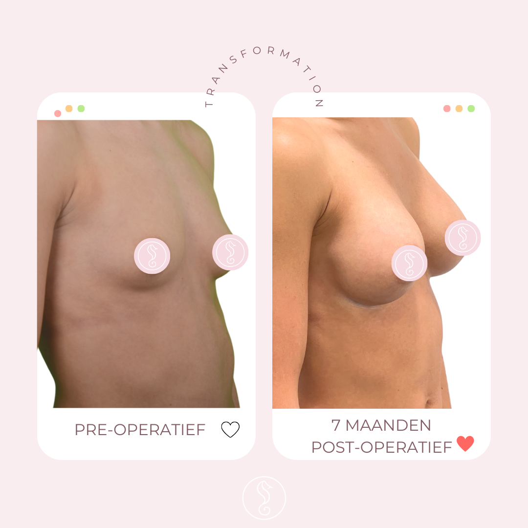 Before and after breast augmentation