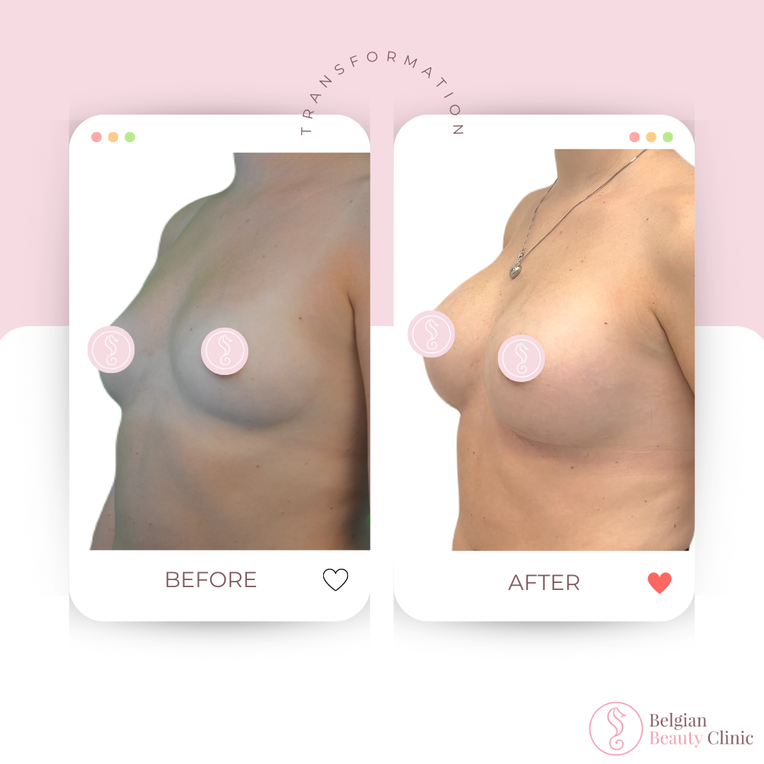 Before and after breast augmentation transformation