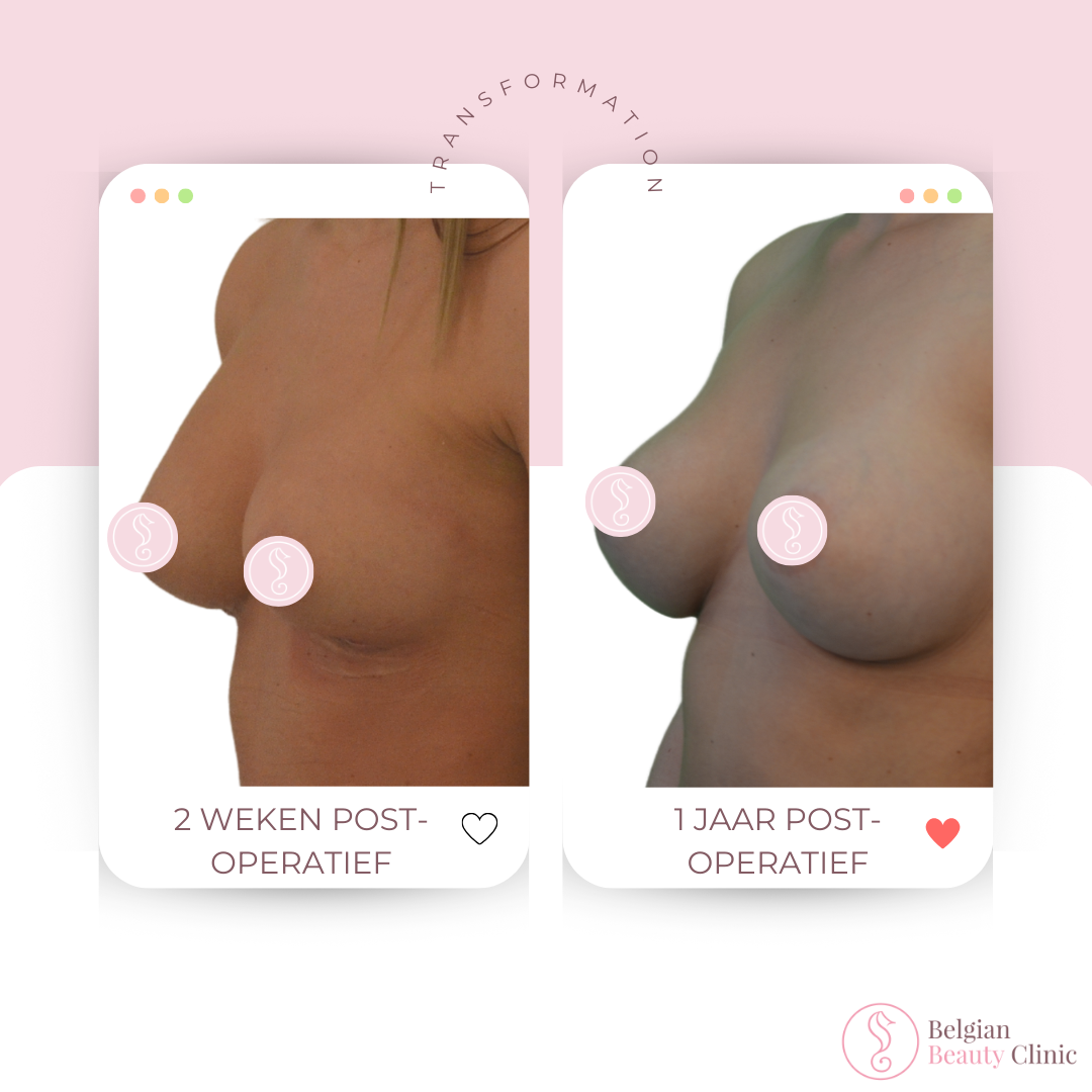 Breast transformation before and after