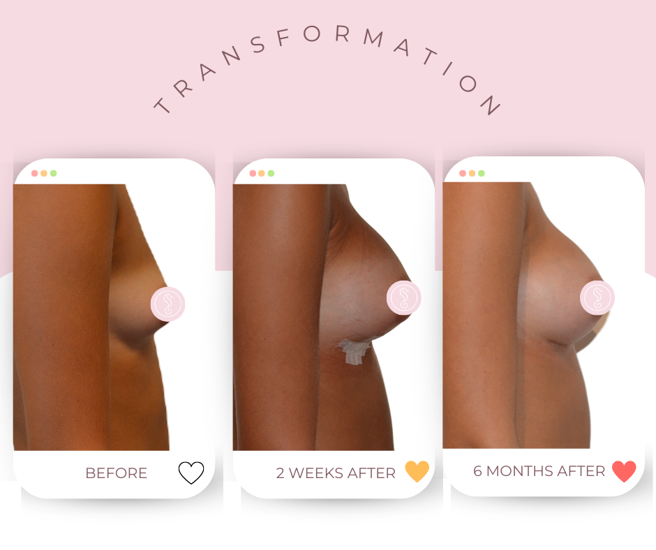 Breast augmentation before and after photos
