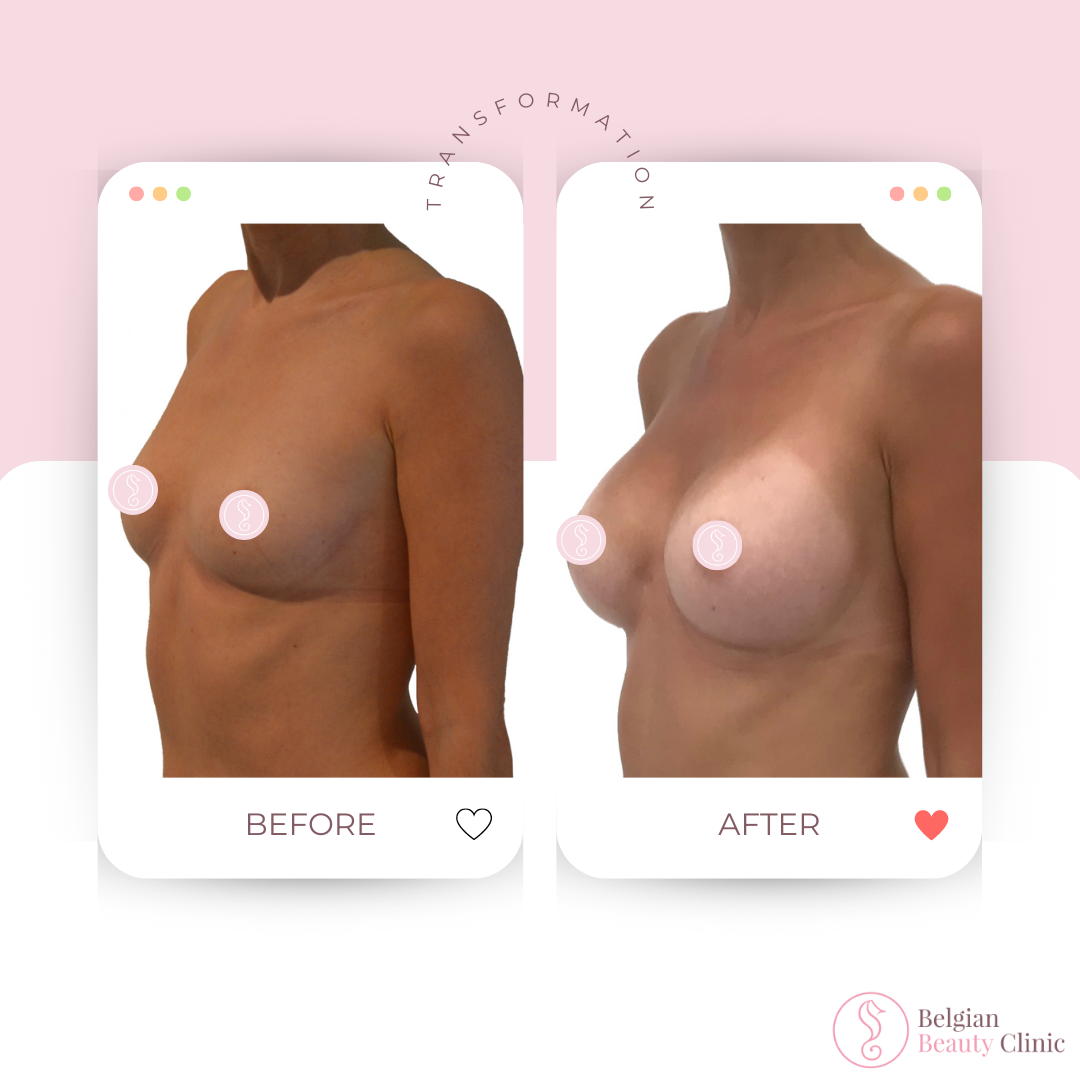 Breast augmentation before and after