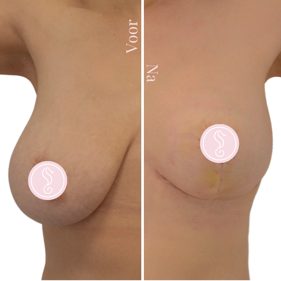 Before and after breast lift surgery
