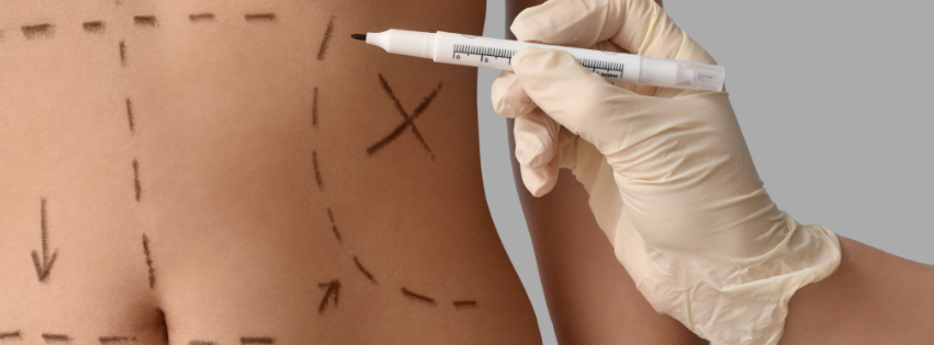 Buikwandcorrectie vs liposuctie 1 a surgeon marking the places of incision on the stomach of his patient