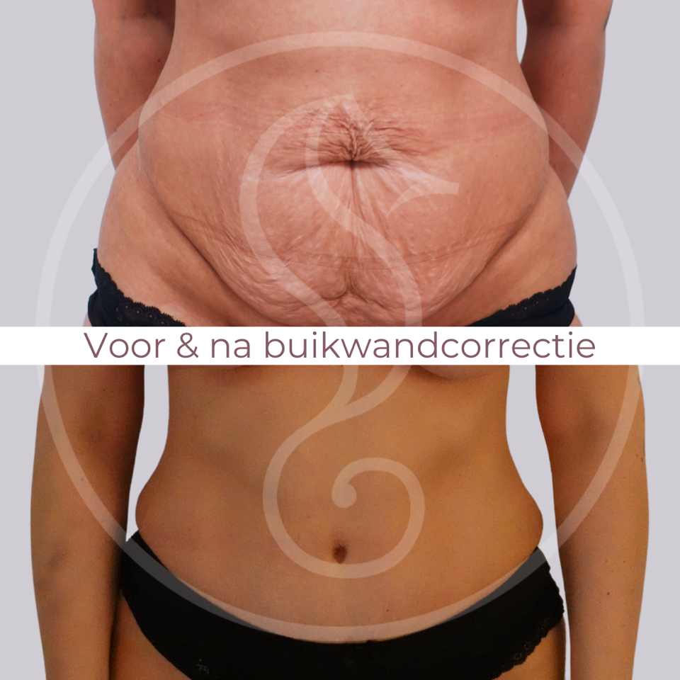 Before and after tummy tuck