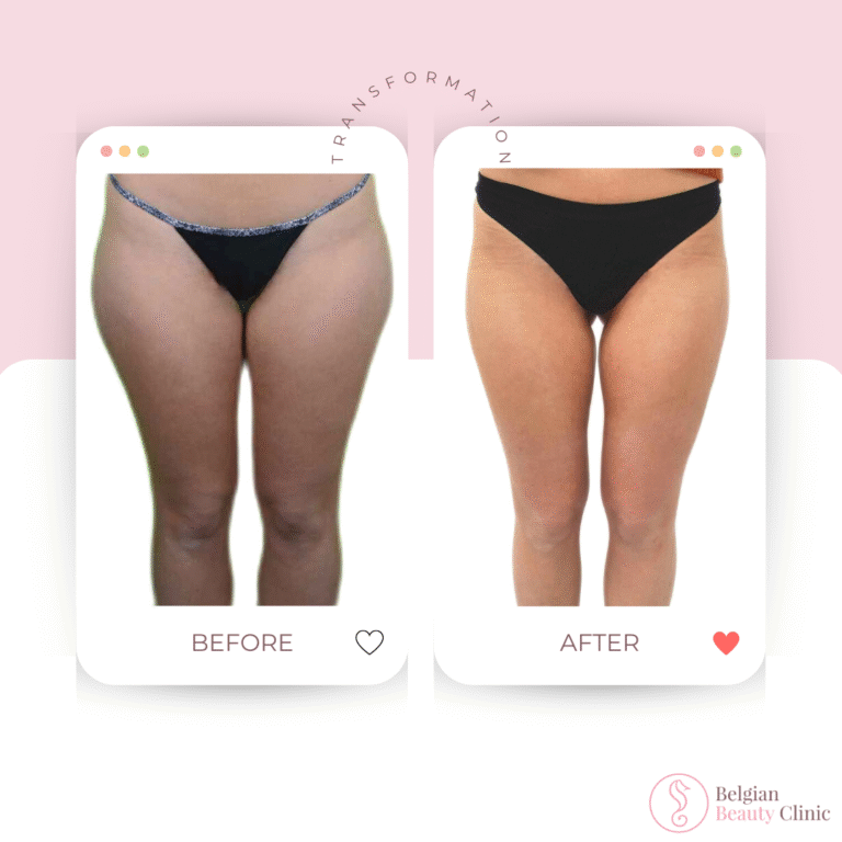 Avant et après une liposuccion des jambes et des hanches