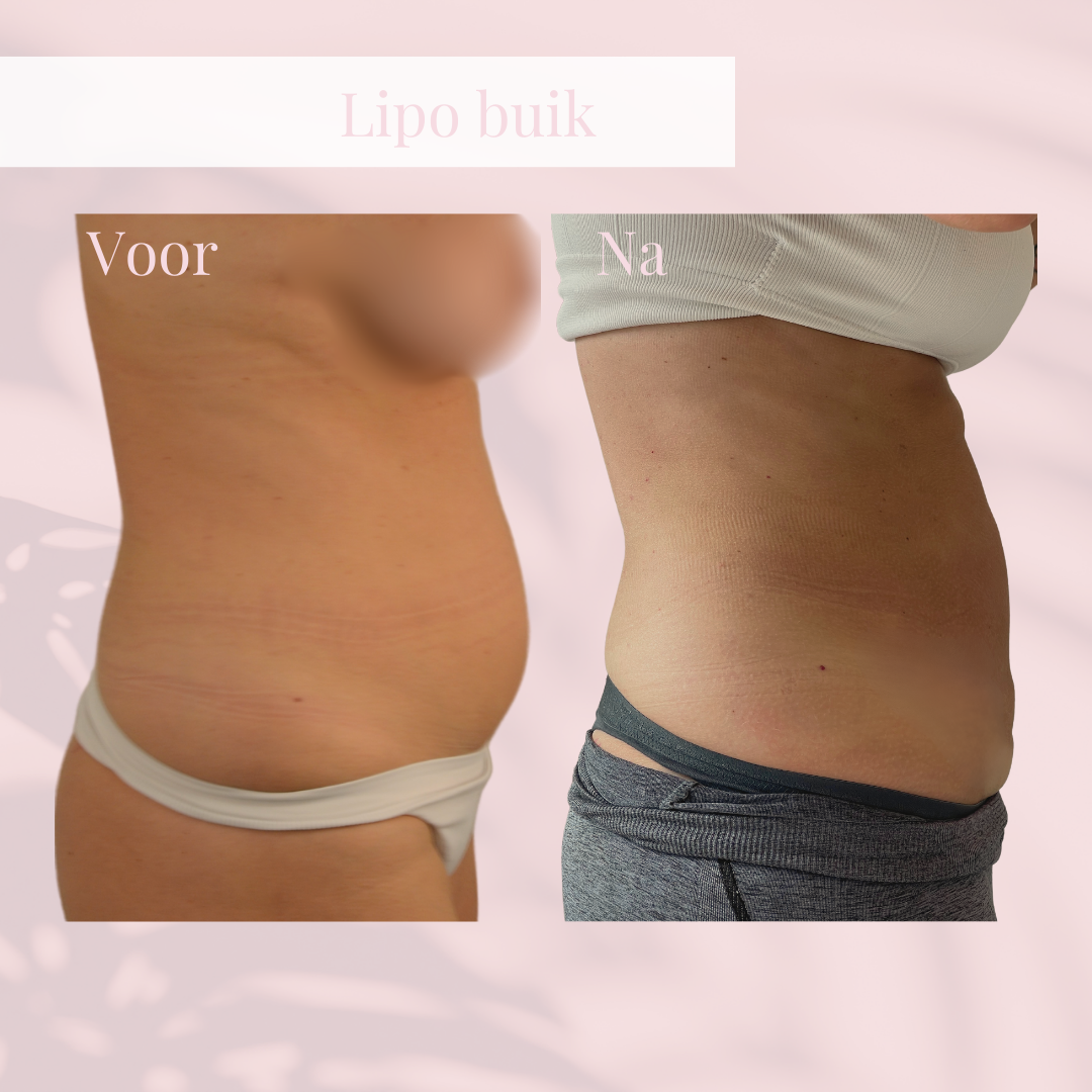 Before and after liposuction comparison