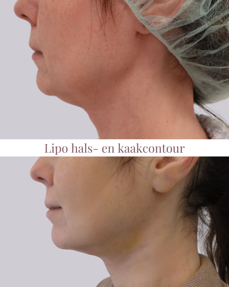 Avant et après une liposuccion du cou et de la ligne mandibulaire
