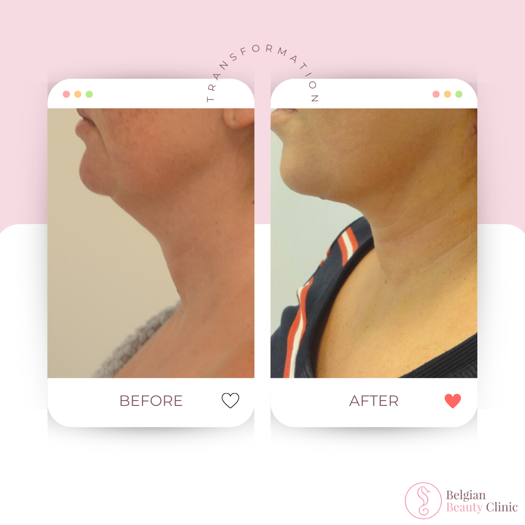 Before and after neck transformation