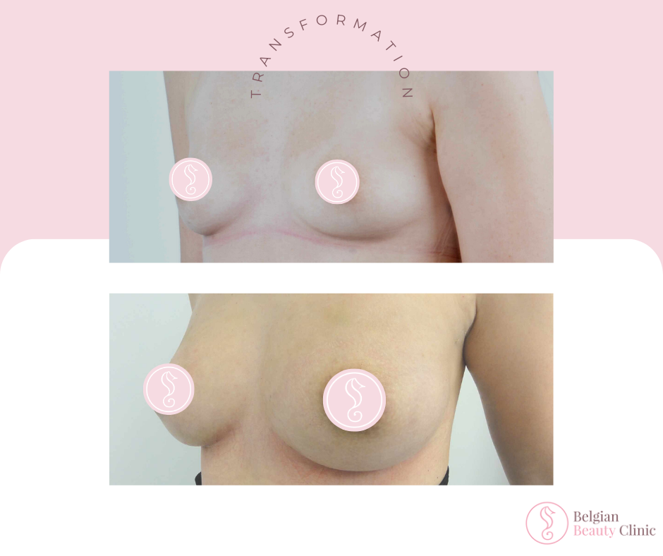 Before and after breast enhancement results