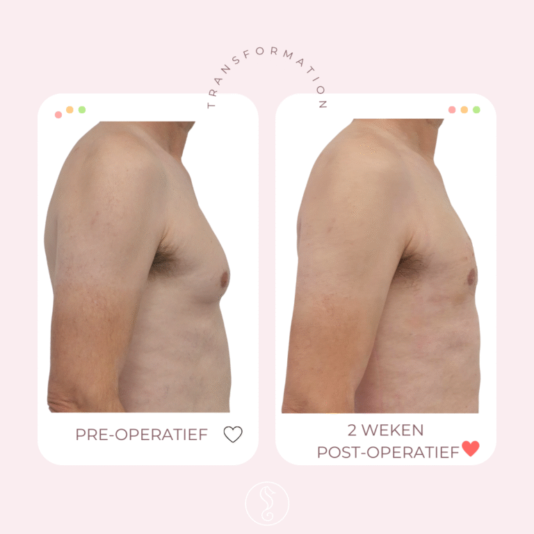 Avant et après une liposuccion de la poitrine masculine
