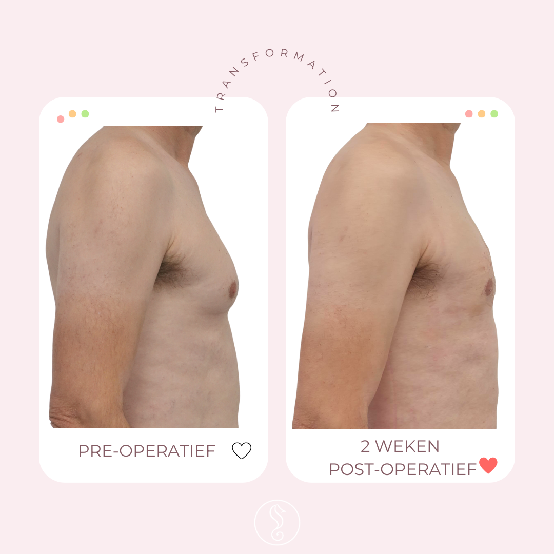 Before and after liposuction transformation