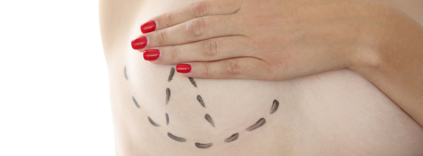 Het litteken na een borstlift: minder zichtbaar dan je denkt 1 Litteken borstlift borstcorrectie