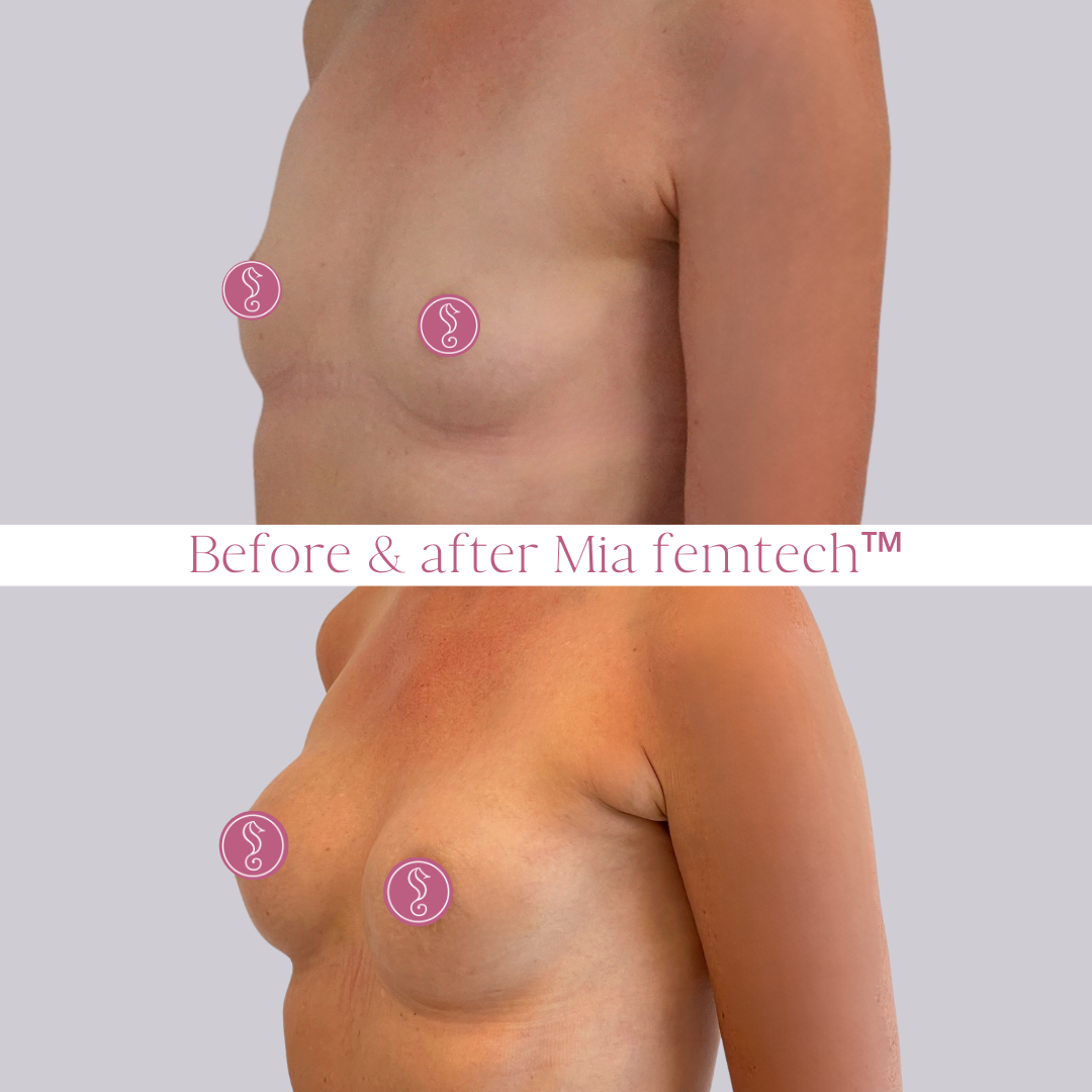 Before and after breast enhancement results