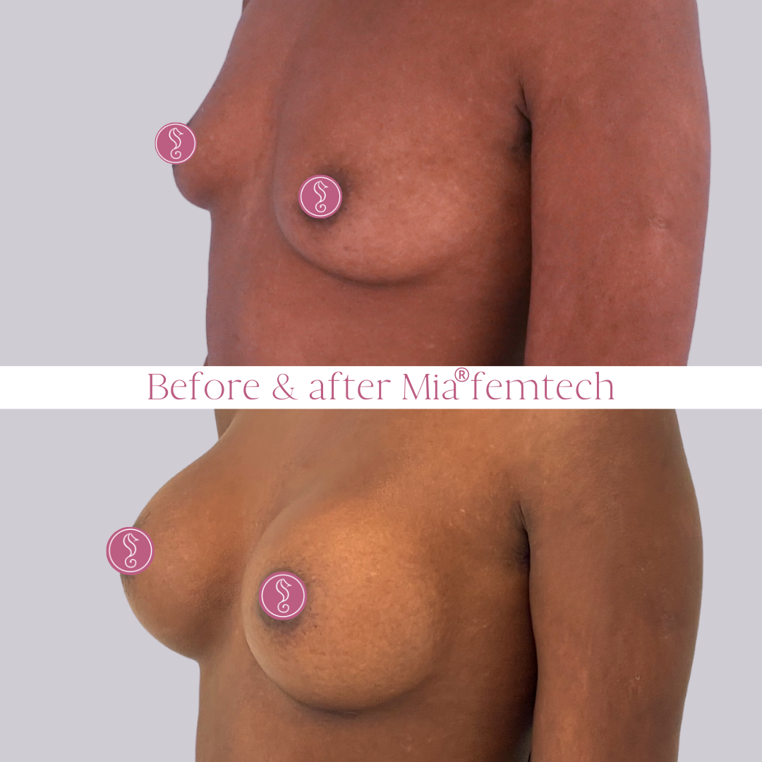 Before and after breast enhancement comparison
