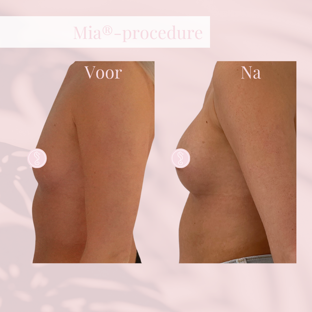 Before and after body transformation