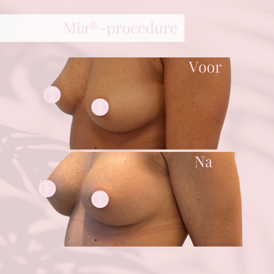 Voor-en-naresultaat na een MIA Femtech borstvergroting 2