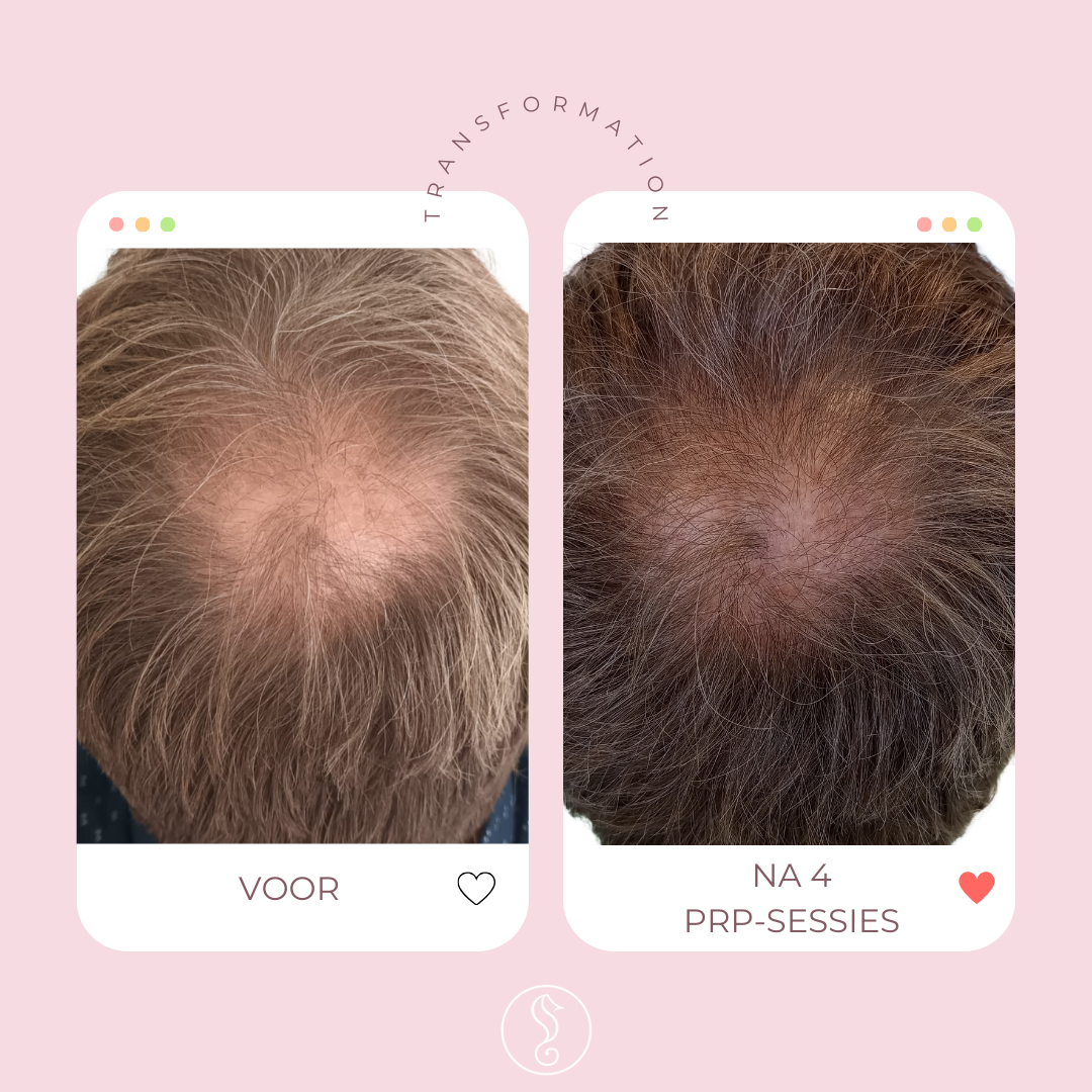Before and after hair restoration treatment