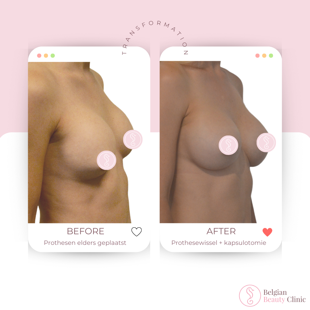 Breast augmentation before and after