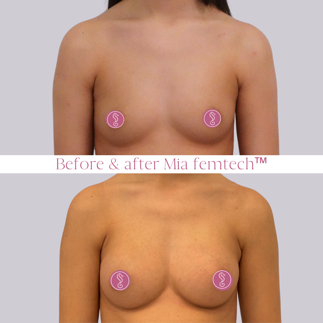 Before and after breast enhancement results