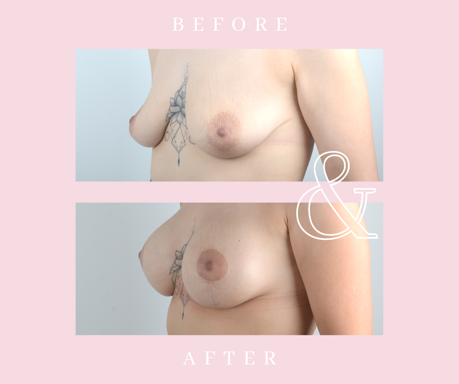 Before and after breast lift results