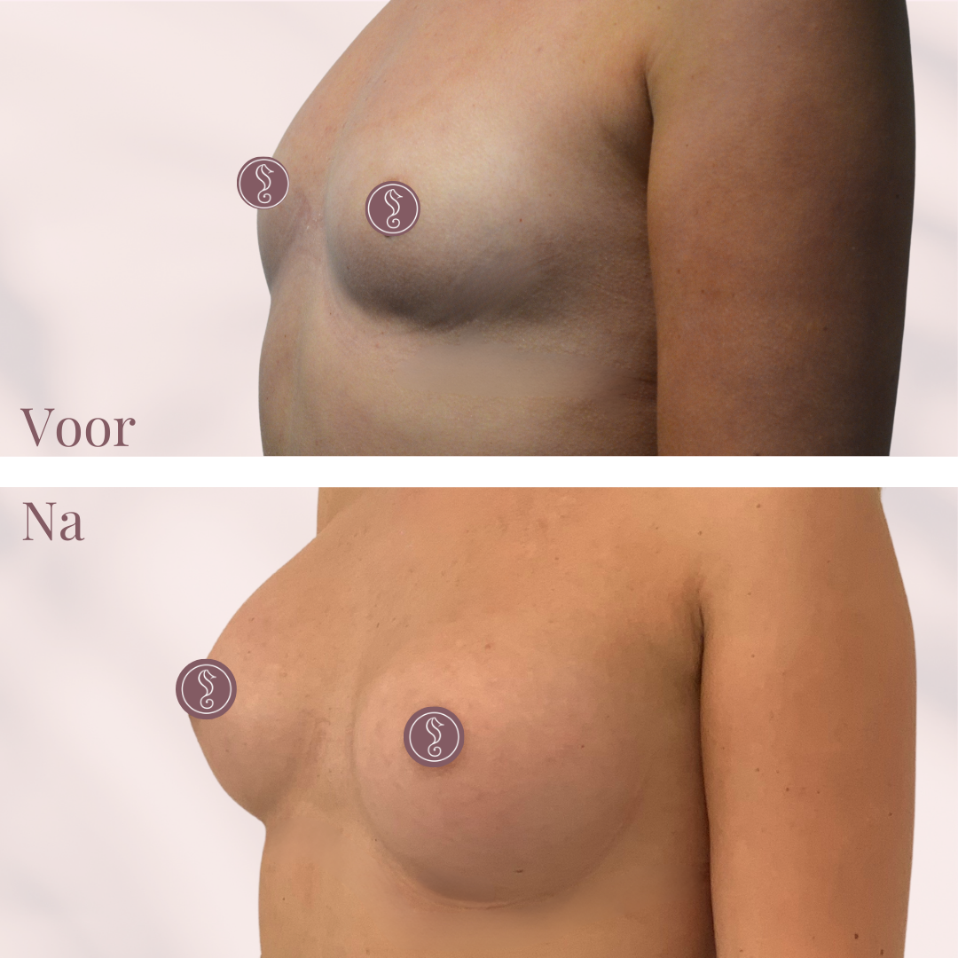 Before and after breast augmentation comparison