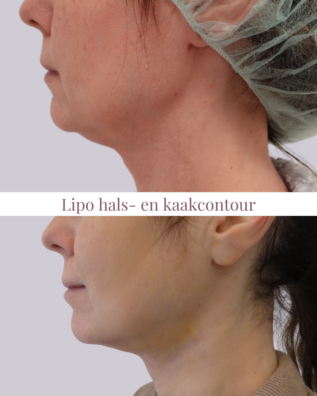 Lipo hals- en kaakcontour