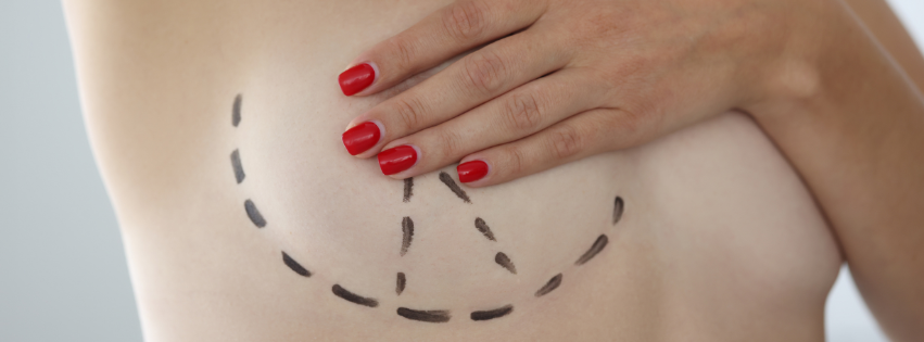 mastopexie borstlift natuurlijk resultaat