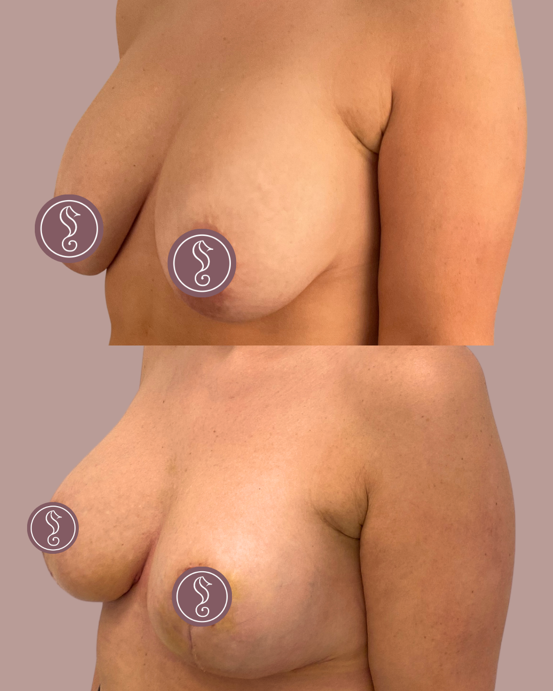 Borstlift met implantaten Motiva prog + demi 300