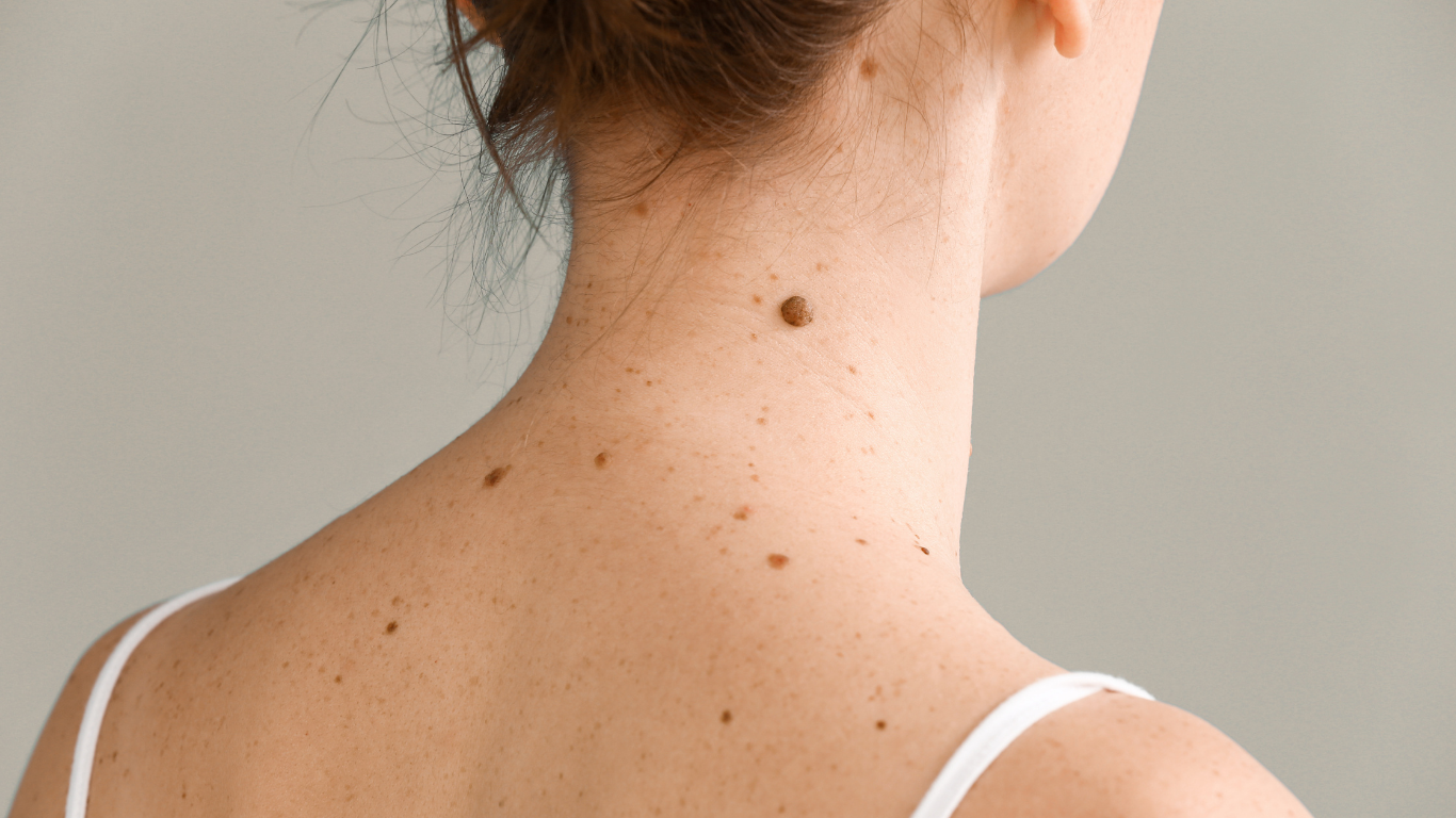 Grains de beauté et taches pigmentaires au niveau du cou et de l’épaule