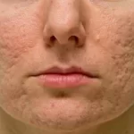 Gezicht met acné littekens