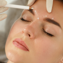 botox fillers rimpels kraaienpootjes botox fillers rimpels kraaienpootjes
