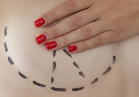 mastopexie borstlift natuurlijk resultaat mastopexie borstlift natuurlijk resultaat