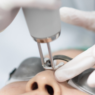 zonneschade laser fotona huidveroudering Fractionele laserbehandeling